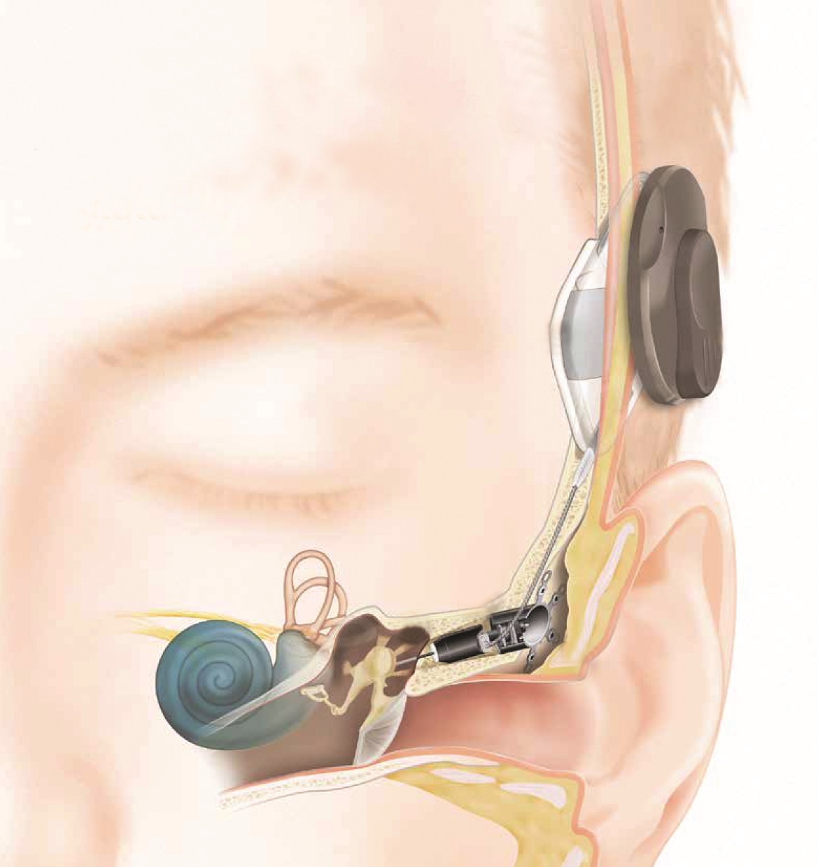 Слуховой аппарат внутреннего уха. МЕДЕЛ кохлеарная имплантация. Катушка Торус 2 кохлеарная имплантация. Слуховой аппарат кохлеарный имплант. Слуховой аппарат Кохлер имплант.